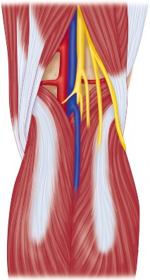 Illustration 11 for PROSTALAC Articulating Spacer: Treat Infected Knees, Regain Mobility