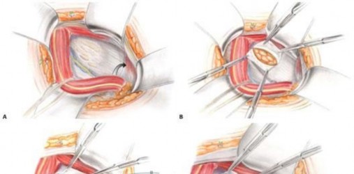 Illustration 105 for Understanding Pubalgia and Adductor Injuries: Your Guide to Relief