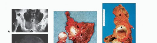 Illustration 26 for Surgical Pelvic Resection: Gluteus Maximus Muscle & Nerve Preservation