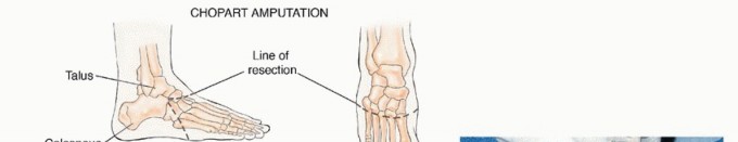 Illustration 26 for Treating Tumors of the Foot: Optimizing Amputation & Resection