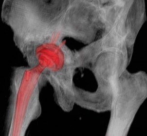 Illustration 10 for Management of Periprosthetic Fractures: An Expert Surgical Guide
