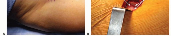 Illustration 13 for Anterior FAI Relief: Mini-Open Anterior Approach Explained