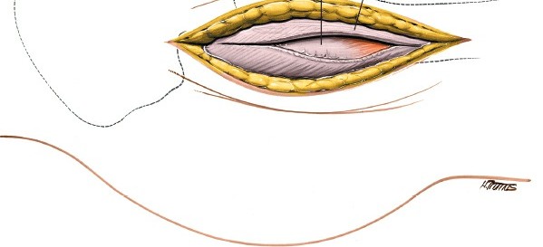 Illustration 132 for Unlocking Every Aspect of the Hip's Surgical Approaches