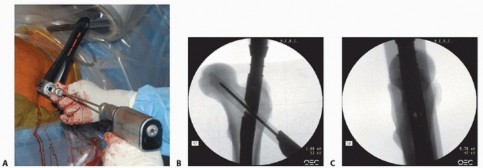 Illustration 29 for Achieve Optimal Femoral Head Fixation with Cephalomedullary Nailing