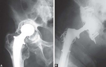 Illustration 24 for Total Hip Replacement for Protrusio: Restore Your Hip Function