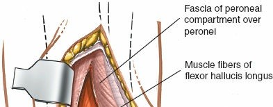 Illustration 73 for Optimized Approaches to the Dorsum of the Foot & Ankle