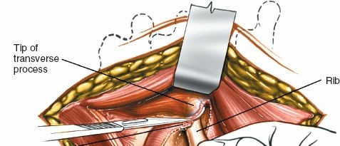 Illustration 299 for Approach to the Lumbar Spine: Mastering Techniques & Anatomy