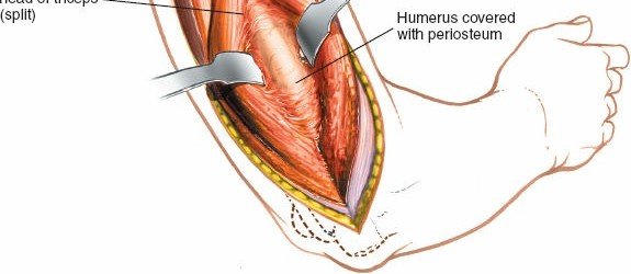 Illustration 45 for Mastering the Approach to the Distal Humerus: Safety & Skills