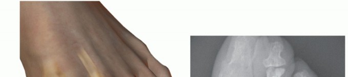 Illustration 39 for Hammer Toe Correction: Understanding the Extensor Digitorum Longus