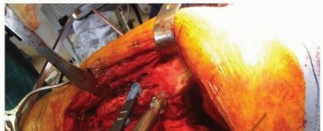 Illustration 13 for Extended Trochanteric Osteotomy: How et al Extended Revision THA Solutions