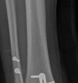 Illustration 7 for Partial Articular Fractureplate Fixation: Restore Anatomy