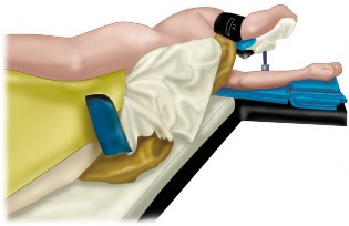 Illustration 27 for Mastering the Cementless Acetabular Cup: Techniques for Optimal Fixation