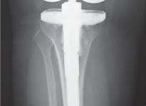 Illustration 67 for Mastering Gap Balancing in Revision TKA: Avoid Common Pitfalls