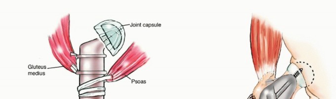 Illustration 22 for Mastering Femoral Metastases: Optimal Function for Femoris & Vastus