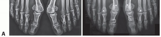 Illustration 34 for Mastering the Biplanar Distal Chevron for Effective Bunion Surgery