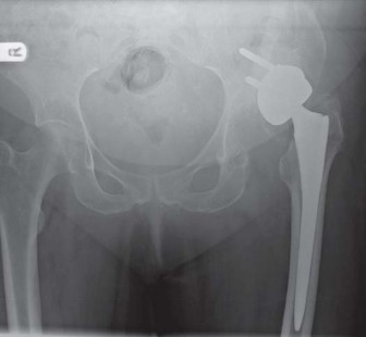 Illustration 17 for Management of Periprosthetic Fractures: An Expert Surgical Guide