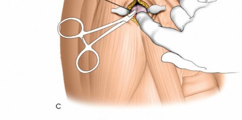 Illustration 25 for Expert Guide: Ulna and Wrist External Fixation Pin Placement