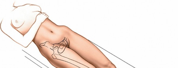 Illustration 26 for Optimal Femoral Approaches: Mastering the Lateral Intermuscular Septum