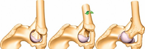 Illustration 138 for Pelvis & Acetabulum Approaches: Unlocking the Posterior Superior Iliac