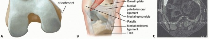 Illustration 2 for Chronic Patellar Instability: From Acute Onset to Lasting Solutions