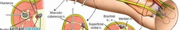 Illustration of fixation of the humerus - Dr. Mohammed Hutaif