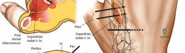 Illustration of ulna and wrist - Dr. Mohammed Hutaif