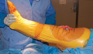 Illustration 52 for Mastering Gap Balancing in Revision TKA: Avoid Common Pitfalls