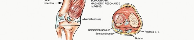 Illustration 12 for Advanced Distal Femoral Resections: Limb-Sparing Outcomes & Techniques