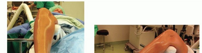 Illustration 12 for Medial Ankle Instability: Find Relief with Reconstruction