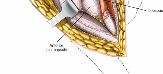 Illustration 46 for Unlocking Every Aspect of the Hip's Surgical Approaches