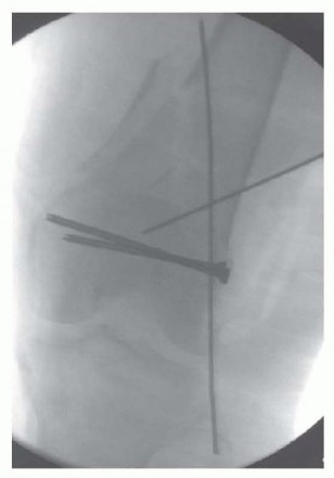 Illustration 72 for Repairing Distal Femur Fractures: Open Reduction & Internal Fixation