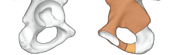 Illustration 52 for Pelvis & Acetabulum Approaches: Unlocking the Posterior Superior Iliac
