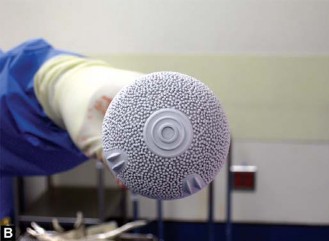 Illustration 28 for Metal on Metal Resurfacing: Enhanced Posterior Soft Tissue Repair