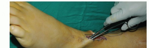 Illustration 48 for Restore Movement: Tendon Transfer for Common Peroneal Nerve Foot Drop