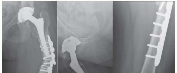 Illustration 29 for Mastering Fixation of Periprosthetic Fractures of the Femur