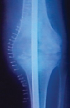 Illustration 23 for Arthrodesis with an Intramedullary Nail: Fixing Failed TKAs