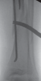 Illustration 16 for Pediatric Tibial Fractures: Avoid Mistakes, Ensure Optimal Healing