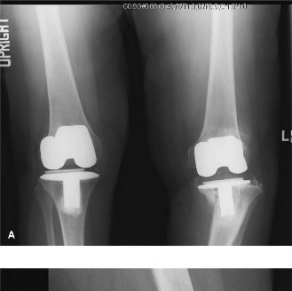 Unraveling Your Painful TKR: Diagnosing Infection & Loosening