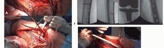 Illustration 20 for Mastering Fixation of Periprosthetic Fractures of the Femur