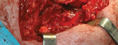 Illustration 106 for Femoral Stem Revision: Posterior Approach for Better Outcomes