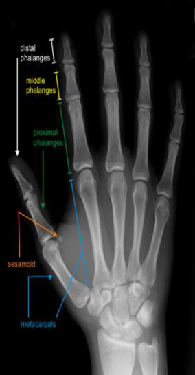 Illustration of carpalmetacarpal joints carpalmetacarpal - Dr. Mohammed Hutaif