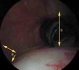 Illustration 2 for Capsular Releases for Loss of Motion: Restore Your Shoulder