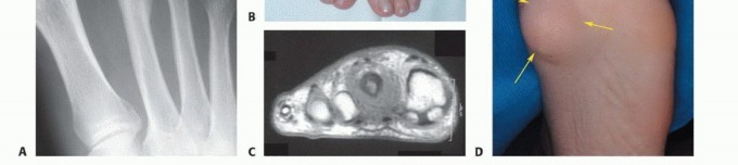Illustration 16 for Treating Tumors of the Foot: Optimizing Amputation & Resection