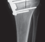 Illustration 50 for Guide Pin Assembly: Key to Flawless Upper Tibial Osteotomy