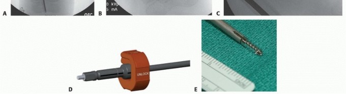 Illustration 18 for Less Pain, More Function: Fassier-Duval Nailing for Osteogenesis Imperfecta