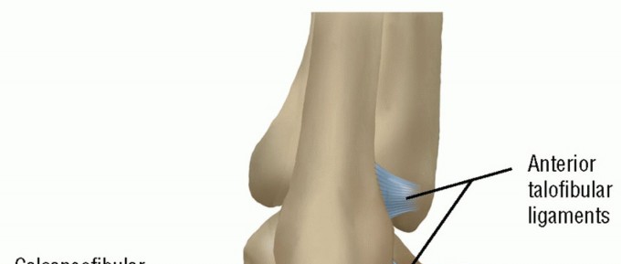 Effective Reconstruction of the Lateral Ankle for Lasting Stability