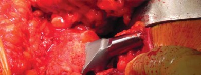 Illustration 48 for Unlock better THA: The technique of short stem for less invasiveness