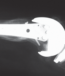 Illustration 10 for Mastering Periprosthetic Femoral Fractures Above Knee Arthroplasty