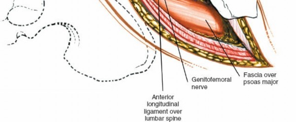 Illustration 22 for Master the Anterolateral Retroperitoneal Approach to Lumbar Spine