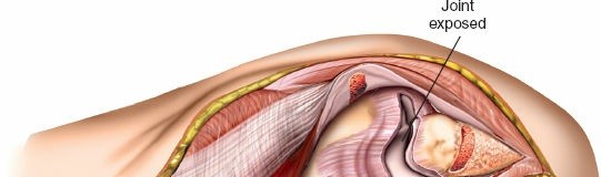 Illustration 23 for Mastering Elbow Approaches: Applied Surgical Anatomy for Precision